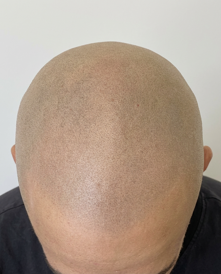 SMP alopecija — posle tretmana
